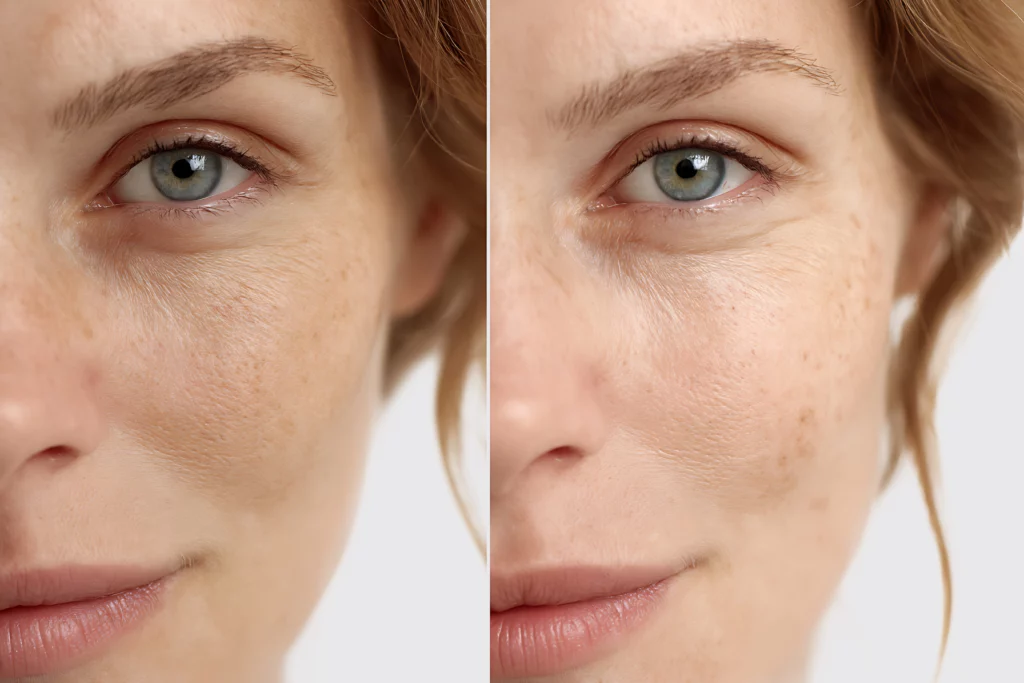 Comparaison avant après du teint d'une femme