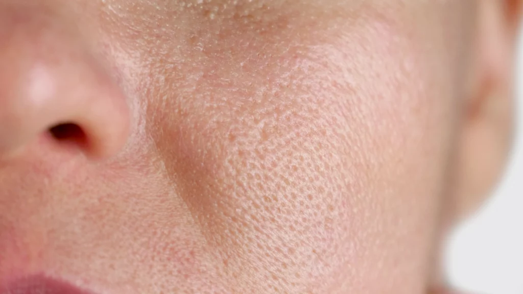 Gros plan sur une peau avec rougeurs et texture visible